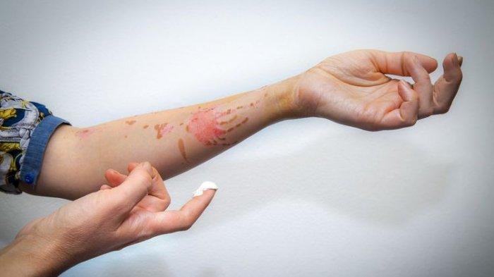 Perawatan Luka Kronis Makin Efektif di RSUD Genteng dengan Skin Graft